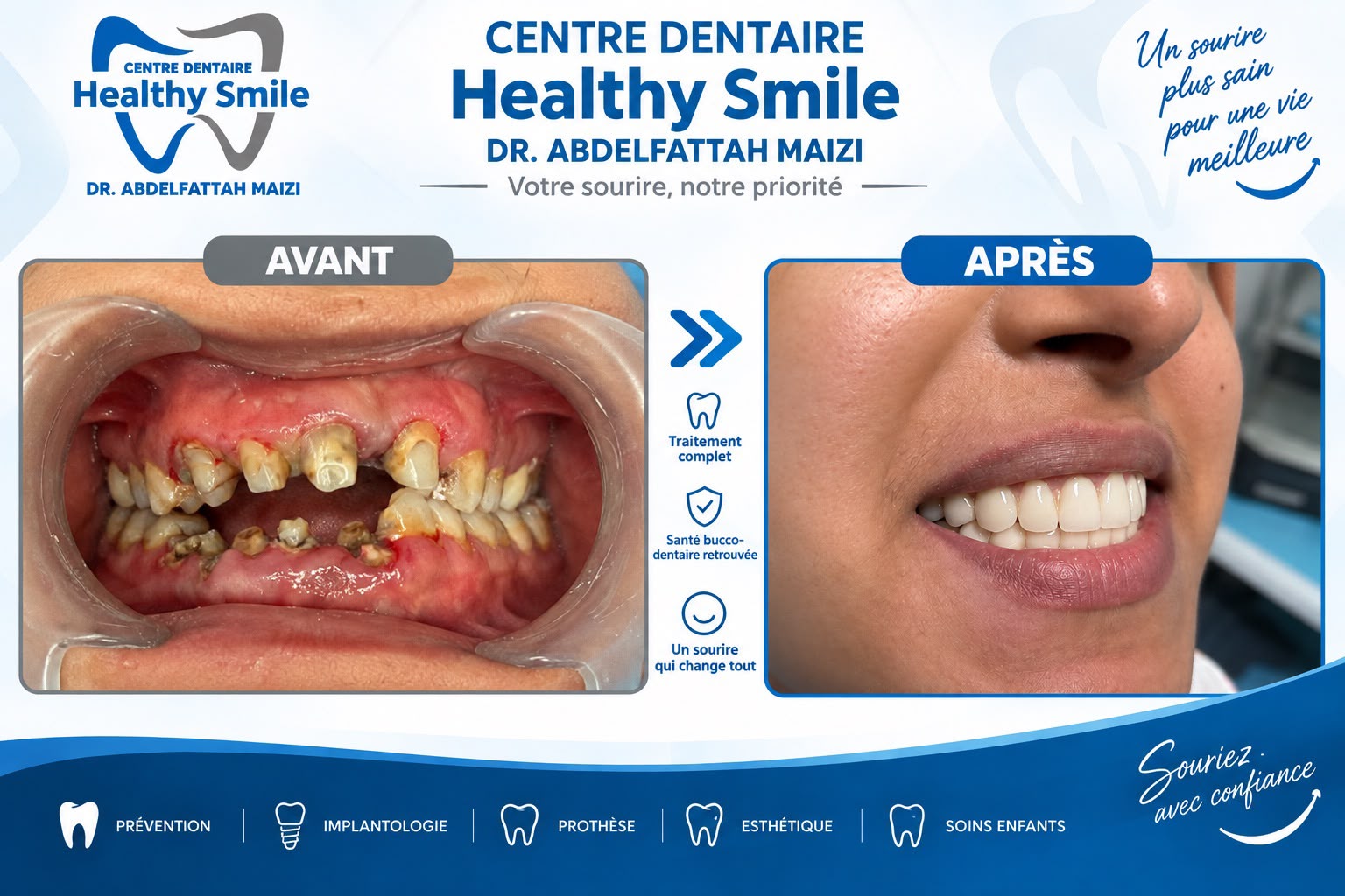 Avant / après complet — réhabilitation dentaire