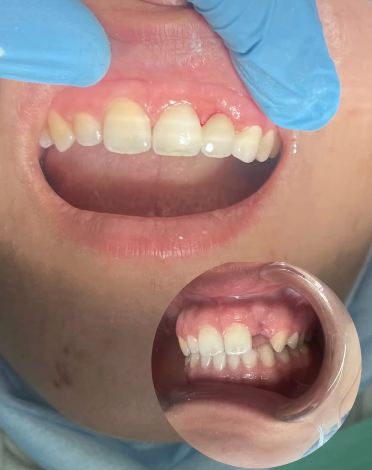 Avant / après — transformation du sourire