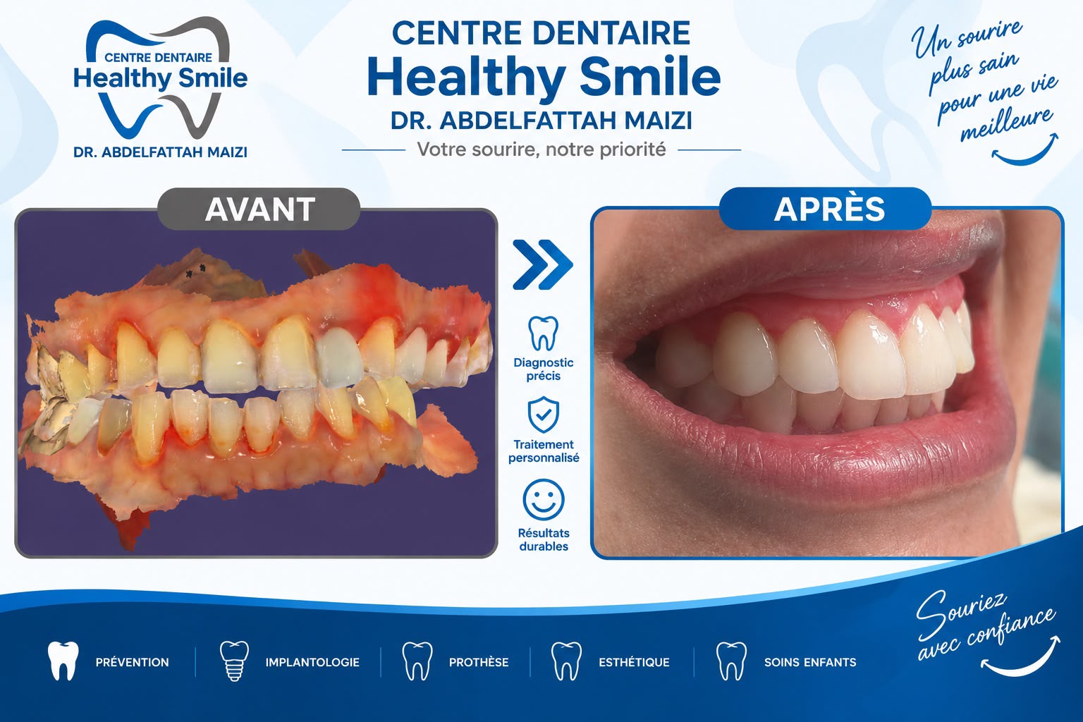 Avant / après — sourire naturel
