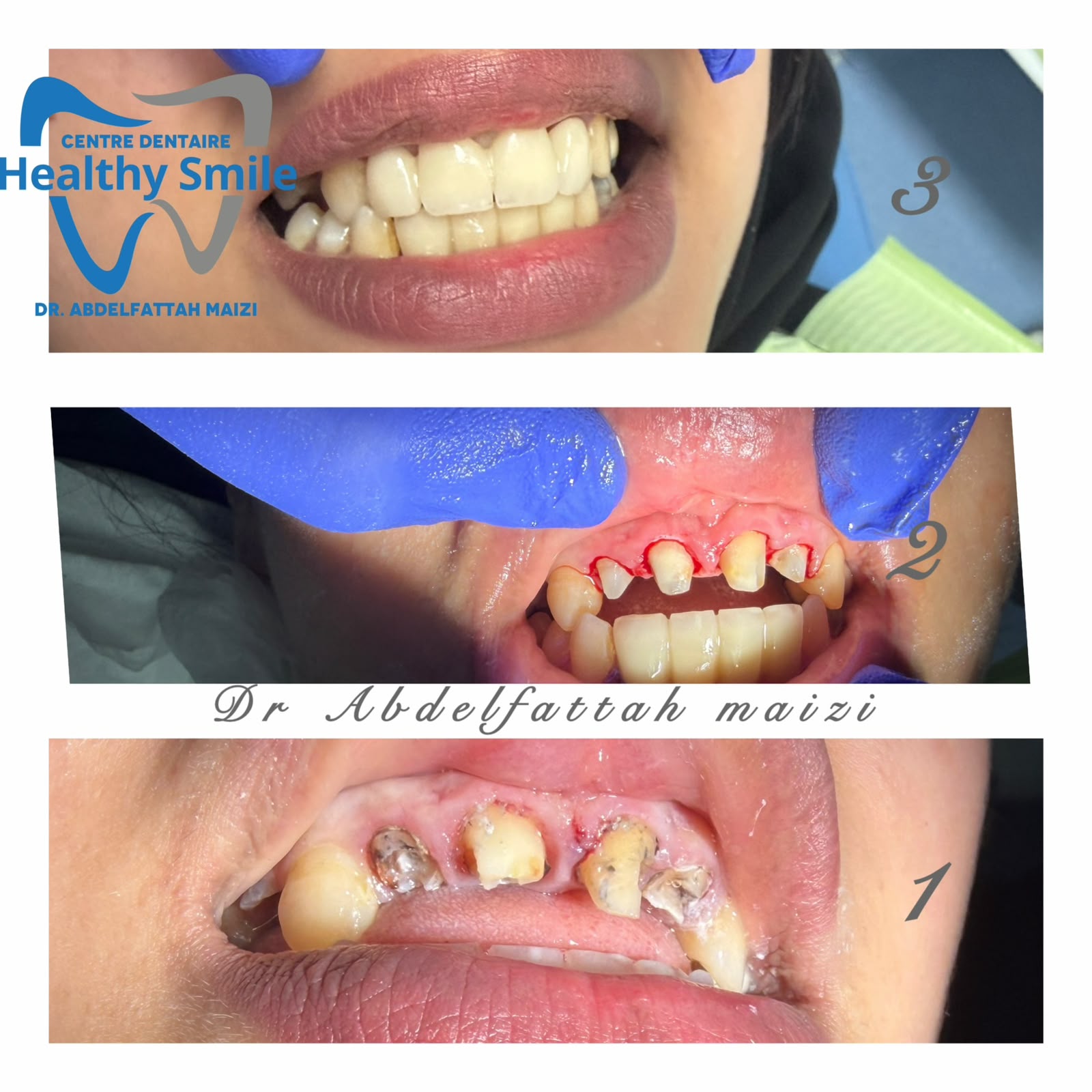 Étapes de reconstruction du sourire