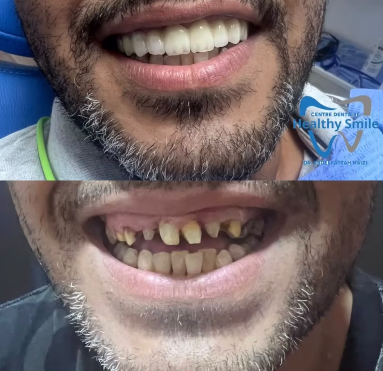 Restauration du sourire — facettes et couronnes
