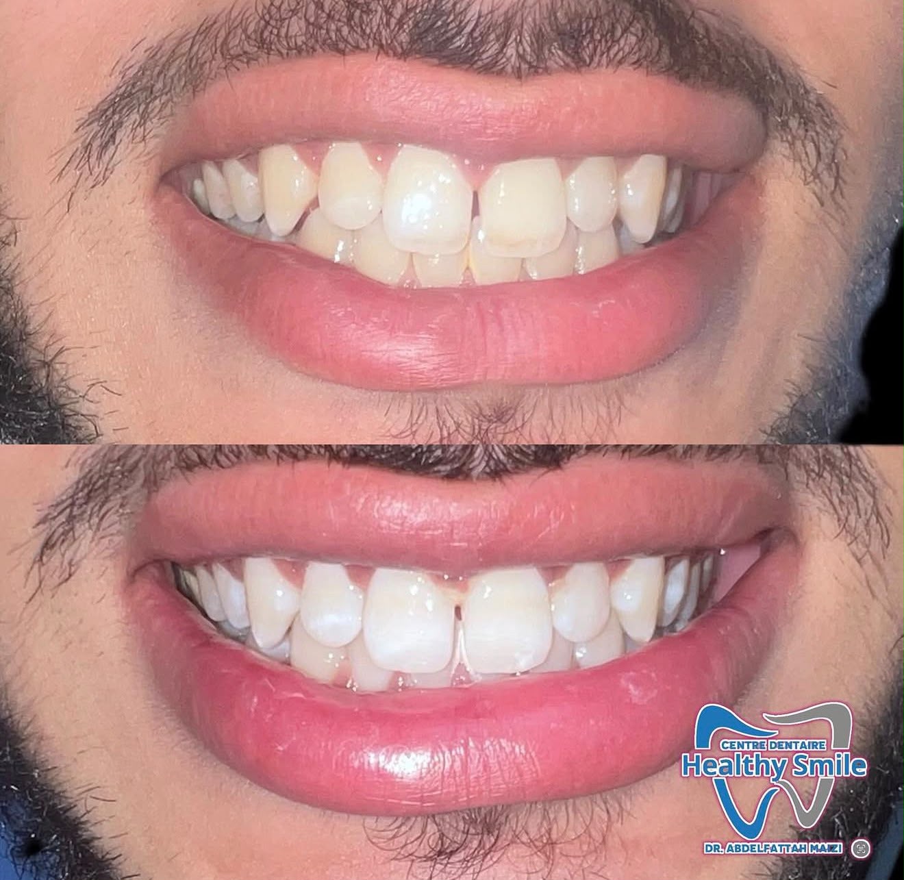 Avant / après — alignement du sourire