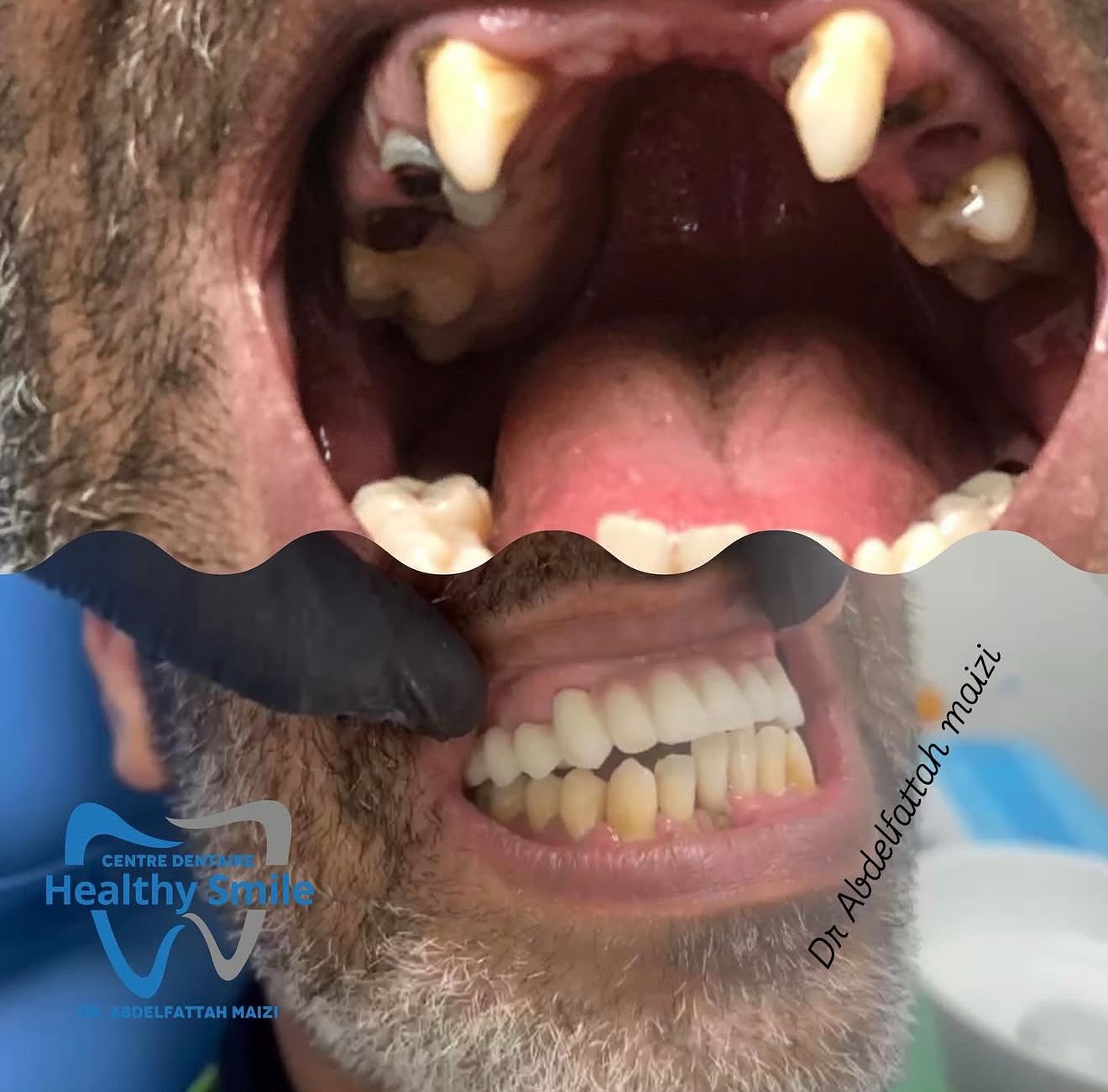 Reconstruction complète du sourire